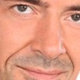 deeper nasolabial creass in me